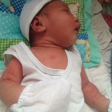 Baby Rashes