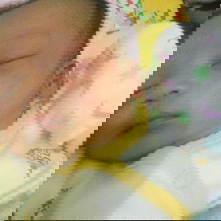 si baby beruntusan d wajah