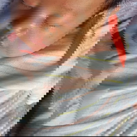 garis diatas bibir bayi