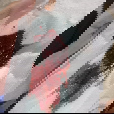 มีลิ่มเลือดออกหลังคลอด 16 วัน มีแม่ๆคนไหนเป็นบ้างจะเป็นไรไหม