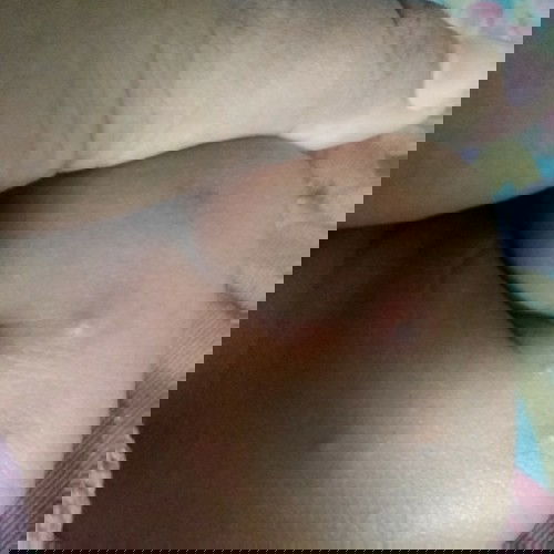 ลูกเเพ้ยุ่ง ยุ่งกัดพอหายเเล้วเป้นสีดำค่ะ เหมือนเเผลเป็นเลยค่ะ