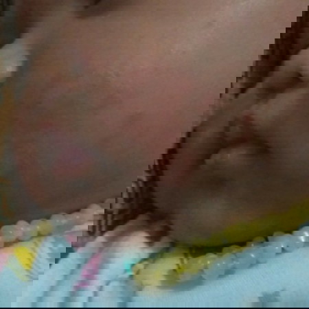 ruam pipi