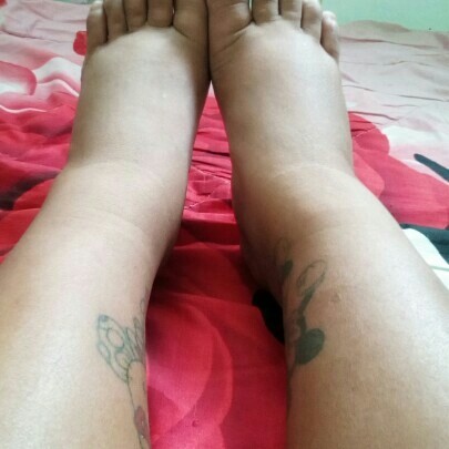 ครรภ์เป็นพิษ