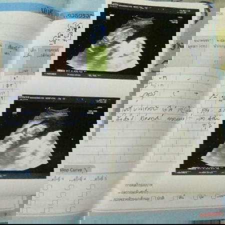 น้ำคล่ำแตกตอน19วีค