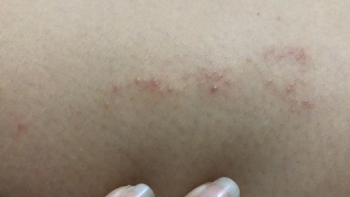 Varicella (cacar air)