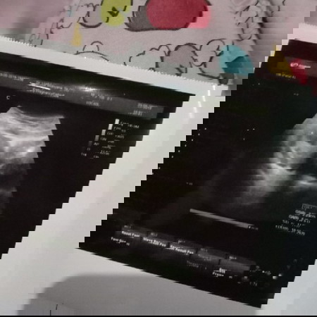 9week baru kelihatan kantung khamilan