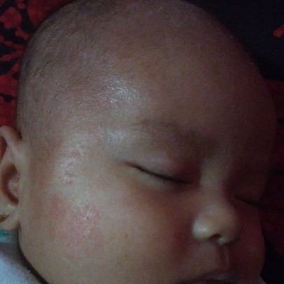 merah" pada bayi