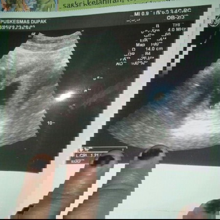 kandungan udh 12 minggu tapi masih kecil kyk 7minggu