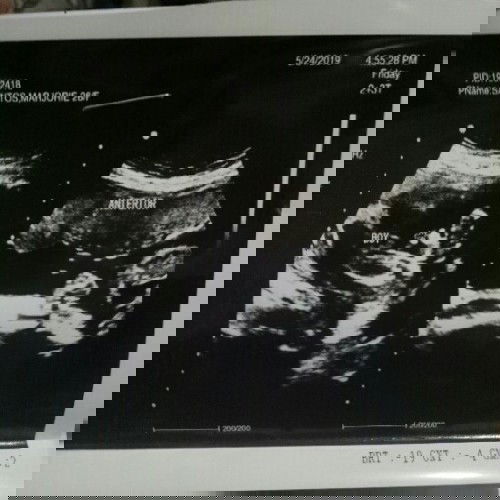 ULTRASOUND
