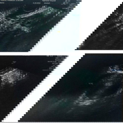 ใช่ถุงตั้งครรภ์และตัวน้องหรือป่าวค่ะ