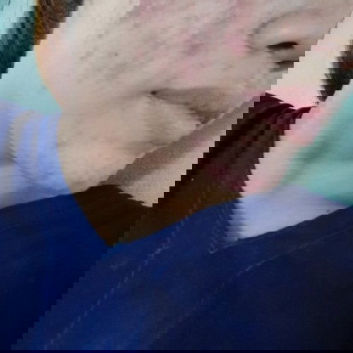 สิวกับคนท้อง