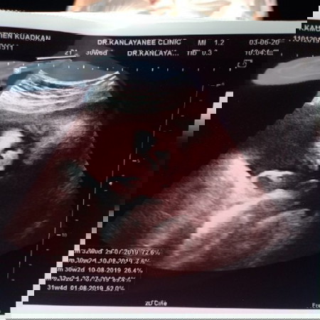 เข้าเดือนที่8แล้วว หมอบอกแก้มเยอะมากๆ