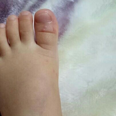 ผื่นแบบนี้ใช่มือเท้าปากไหมค่ะขออภัยภาพไม่สุภาพน่ะค่ะ