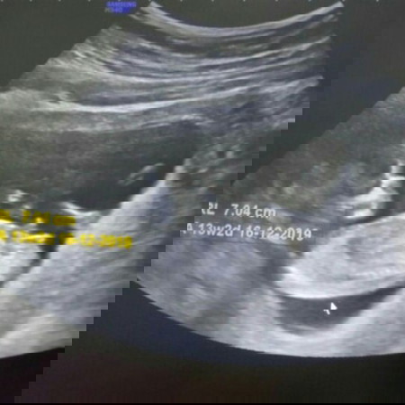 13w 2d สามารถดูเพศได้รึยังคะ หมอไม่ยอมบอกเพศลูก