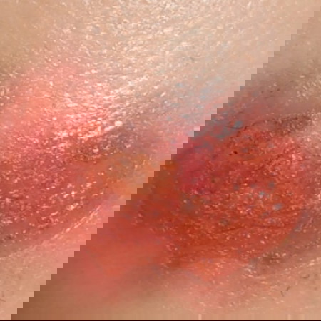 luka gigitan serangga bayi 7bulan