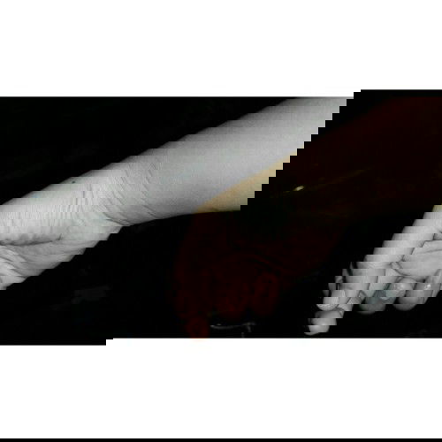 carpal tunnel syndrome