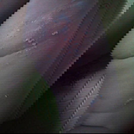 bintik berisi air disekujur tubuh