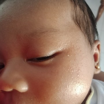 Beruntusan pada bayi