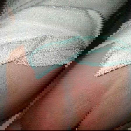 diaper rash