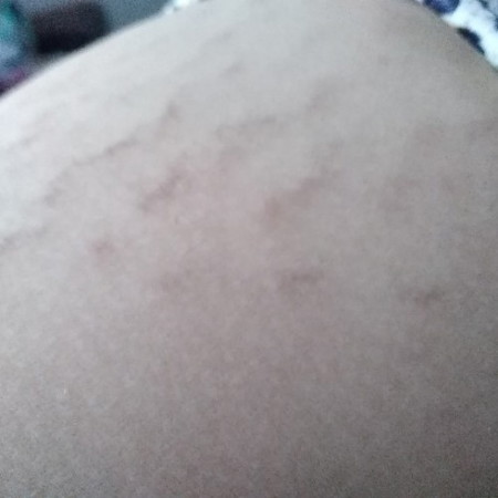 Stretch marks