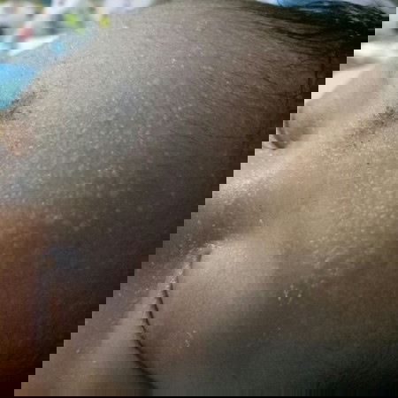 Bruntusan pada dahi bayi