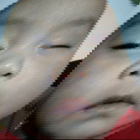 sakit mata