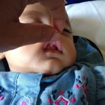 lip tie