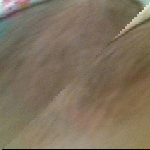 kepala merintis merah merah dan pipi juga tangan ada merintis merah merah