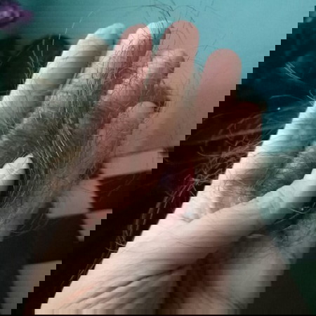 Post partum hair loss