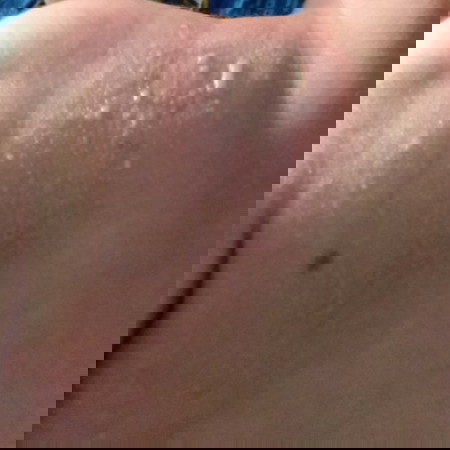 Bayi herpes/karurawit