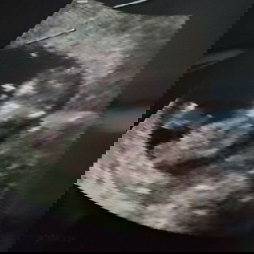 I'm PCOS and I'm pregnant