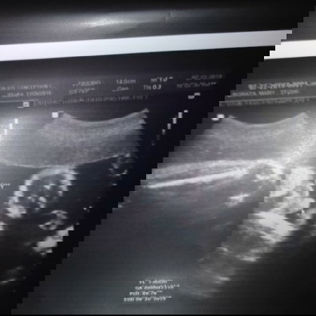 Ultrasound result