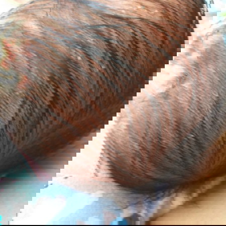 bintik bintik pada bayi