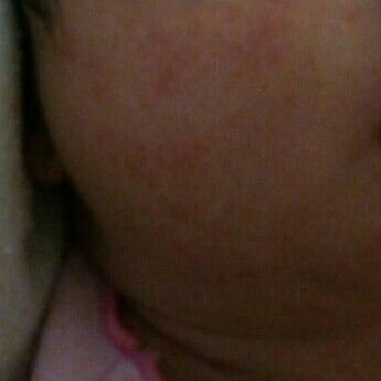 bintik merah di muka baby 3 minggu