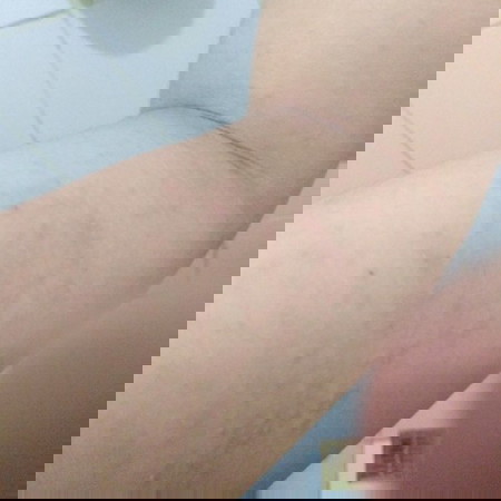 Sugat, Rashes, Pangangati