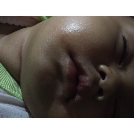 bruntusan pada bayi