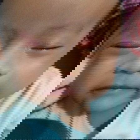 tanda merah dikelopak mata