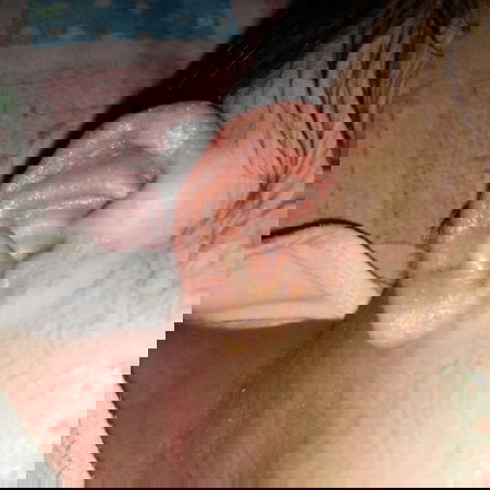 Rashes