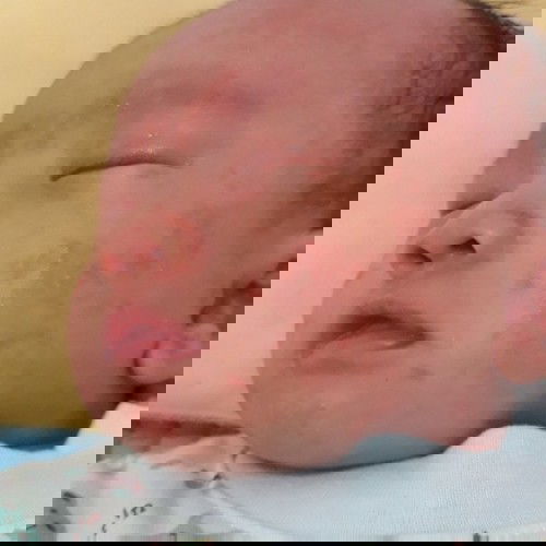 bintik" di seluruh badan bayi