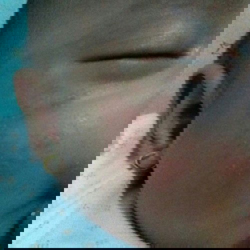 Pipi Bayi 2 Bulan Beruntusan Merah & Gatal