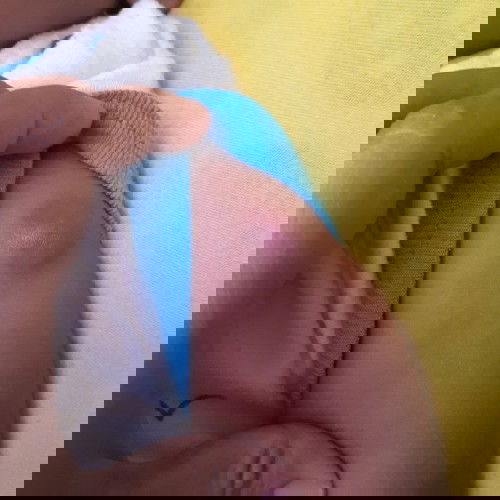 benjolan stlh imunisasi bcg