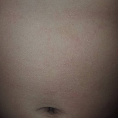 ลักษณะอาการภูมิแพ้ของเด็กทารก