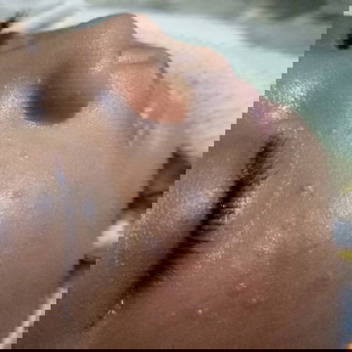 bruntusan pipi bayi karna Asi?