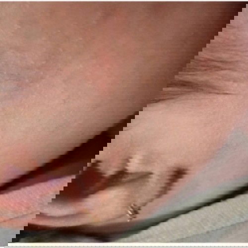 Cara obati biang keringat gimana?