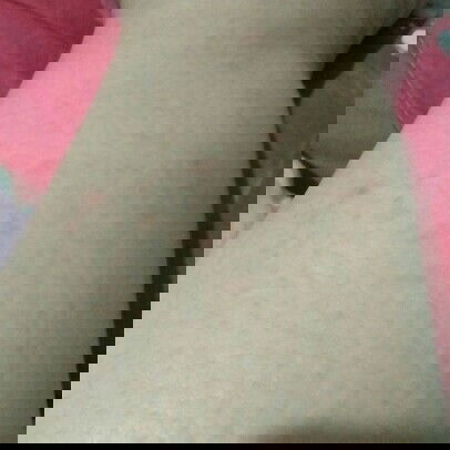 kaki bintik2 merah gatal