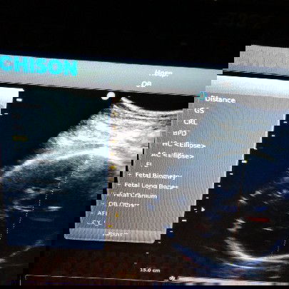 usia d usg udh 9 bln..