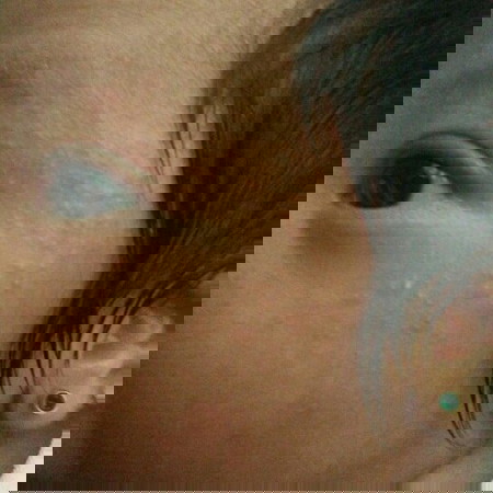 Baby Pimples