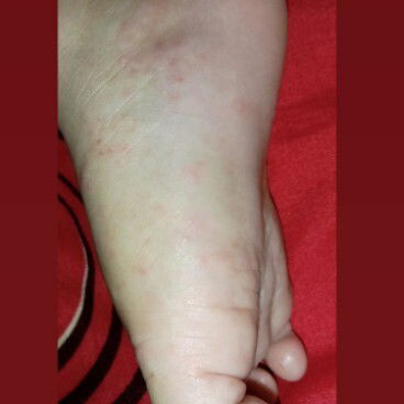 bruntusan dan gatal!