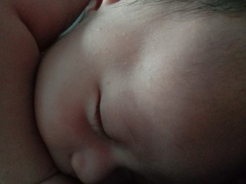 bintik pada kulit anak