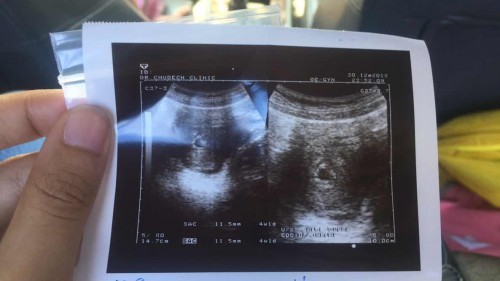 อาการคัดตึงเต้านมหายไป